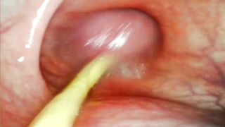 EXTREME ANAL POV. CAMERA INSIDE HER ASSHOLE AS I POUND HER WITH MY BIG COCK AND CUM DEEP INSIDE