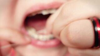 My 2nd day in braces: cleaning by dental floss