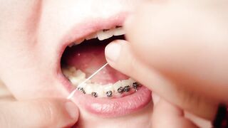 My 2nd day in braces: cleaning by dental floss