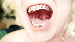 My 2nd day in braces: cleaning by dental floss