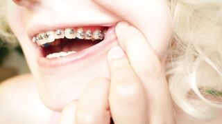 My 2nd day in braces: cleaning by dental floss