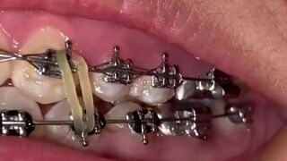 Mira que tanto metal tengo en mi boca ????