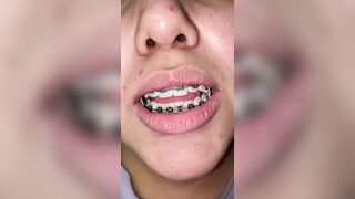 Mira que tanto metal tengo en mi boca ????