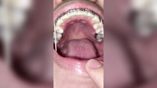 Mira que tanto metal tengo en mi boca ????