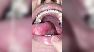 Mira que tanto metal tengo en mi boca ????