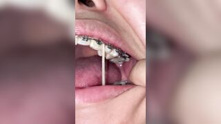 Mira que tanto metal tengo en mi boca ????