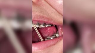 Mira que tanto metal tengo en mi boca ????