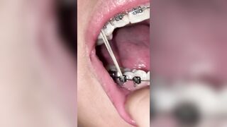 Mira que tanto metal tengo en mi boca ????