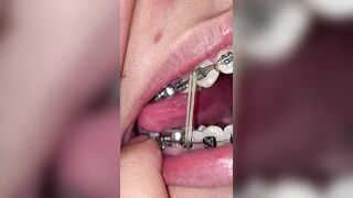 Mira que tanto metal tengo en mi boca ????