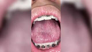 Mira que tanto metal tengo en mi boca ????